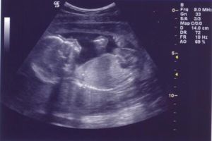 ultrasound5.jpg